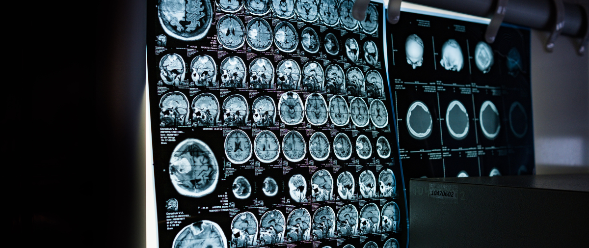 AI in Healthcare: how AI is revolutionising the field of medical imaging